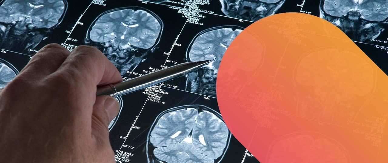Artikel-Bild von Schon mal gehört: Hirnatrophie bei MS?